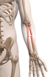 bone-injuries