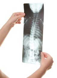 childrens-scoliosis