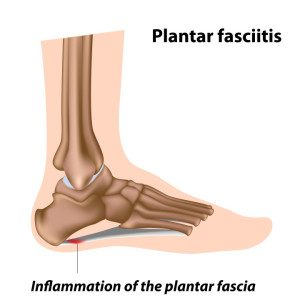 Over stretching of the plantar ligament causes micro trauma